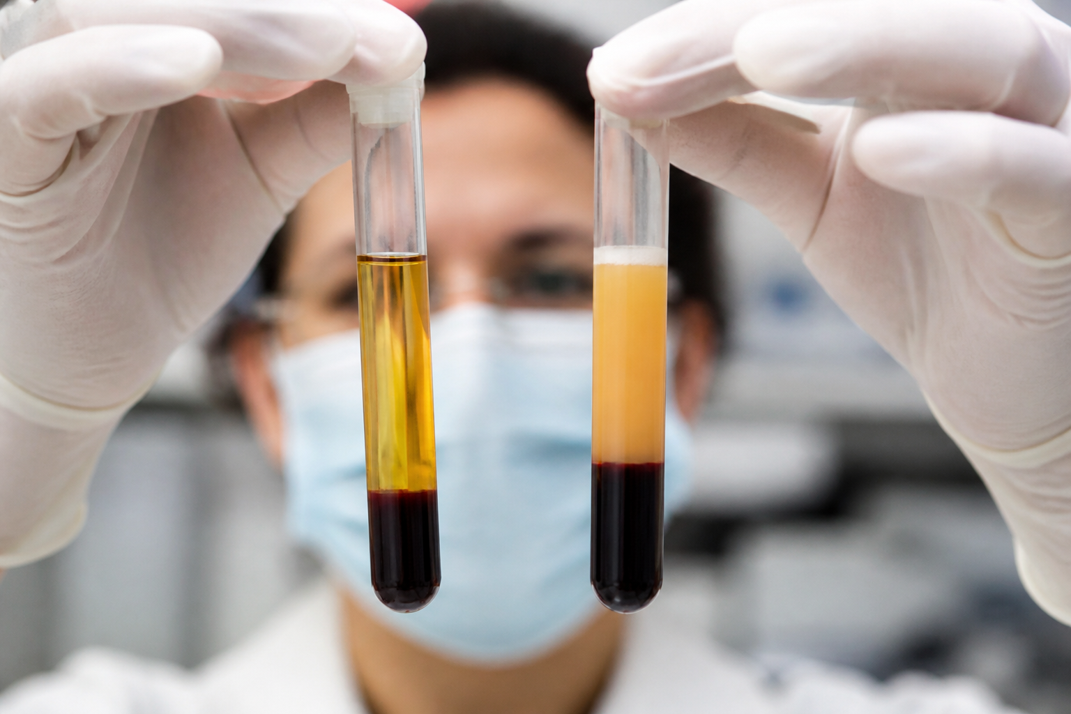 A scientific comparison showing two test tubes, one with clear golden plasma and one with cloudy lipid-rich plasma, laboratory setting.